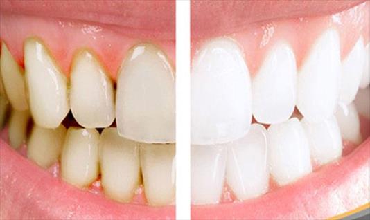 Uno de cada tres adultos presenta desgaste dental