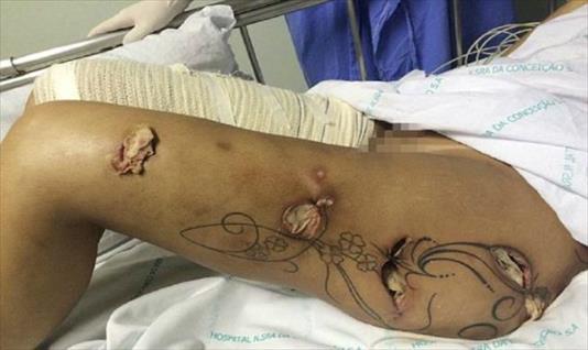 Brasil: Las secuelas de una modelo que se sometió a cirugías extremas 